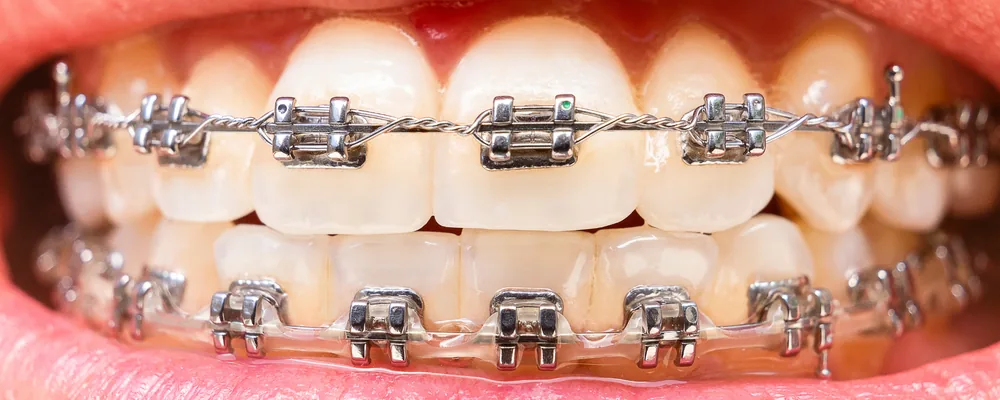 部分矯正はワイヤーとマウスピースどっち？装置の選び方｜シティデンタルクリニック そよらリーフシティ市川